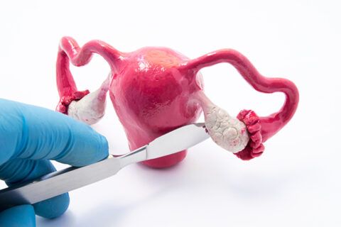 Uterine Fibroid Removal (Myomectomy)