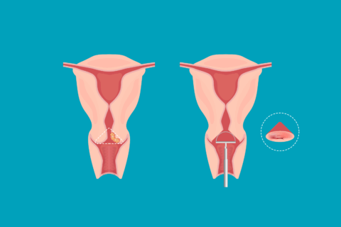 LEEP (Loop Electrosurgical Excision Procedure)