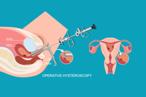 Hysteroscopy